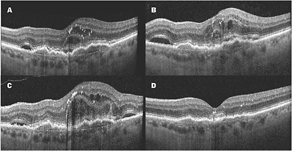 Figure 1. OCT is crucial for evaluating the need to switch treatment. Although vision remained stable in the near term, this monocular patient with wet AMD exhibited a poor response to multiple monthly injections of an anti-VEGF agent, images A-C. One injection of a different anti-VEGF agent yielded significant improvement and macular drying, image D.