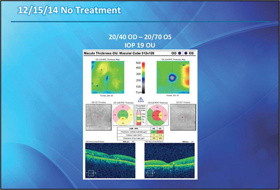 FIGURE 3. After suboptimal response to anti-VEGF therapy, the patient received the dexamethasone 0.7 mg intravitreal implant, which produced improvements in both macular edema and visual acuity.