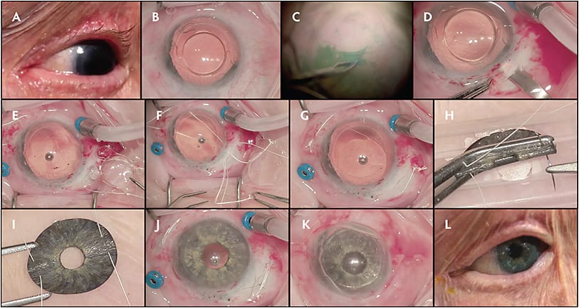 Figure 3. Near-complete aniridia in the left eye (A), an endothelial keratoplasty, a phacoemulsification burn with scleromalacia, and an over-tightly sutured Akreos intraocular lens (IOL; Baursch + Lomb) (B) yield counting-fingers vision in this multiply operated eye after cataract surgery complicated by intraoperative floppy iris syndrome. An epiretinal membrane is present posteriorly. A pars plana vitrectomy and epiretinal membrane peel are performed (C). A 7.0-mm scleral tunnel is created (D). Four sclerotomies are created and CV-8 Gore-Tex suture loops are passed into the eye (E). The Akreos IOL is removed. The suture loops are externalized though the main IOL wound and attached via girth-hitch knots to the haptics of an Alcon CZ70BD IOL (F). The IOL is in position and the sutures have been tied (G). The “with fiber” Customflex Artificial Iris Prosthesis (CFIP; Humanoptics) is folded in half (H) with a Nugent forceps, and Gore-Tex sutures are affixed (I). The sutures are passed through the sclerotomies, and the CFIP is refolded and placed into the anterior chamber (J). The intraocular lens–CFIP wound is closed with 10-0 nylon, the sutures are tied, and 1 of 2 suture knots is rotated into the eye. The remaining Gore-Tex knot is rotated into the eye, an air–fluid exchange is performed, and Tenon’s capsule and the conjunctiva are closed (K). The postoperative visual acuity result is 20/70, with no glare and excellent cosmesis (L).