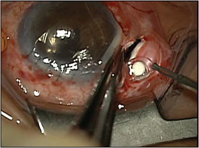 Figure 1. A Retisert implant (Bausch + Lomb) explanted through a sclerotomy.