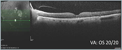 G: Status 12 weeks after treatment class switch OS