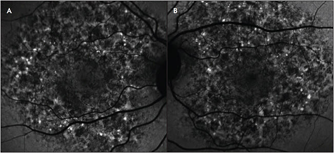 Figure 2. Fundus autofluorescence images of a patient with pentosan polysulfate sodium toxicity (A, right eye; B, left eye). Note the symmetric, speckled increased and decreased autofluorescence in a large zone centered on the fovea.