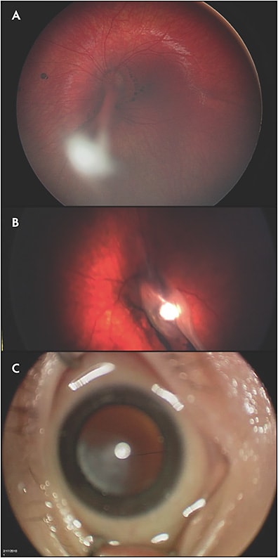 Figure 5. Different presentations of persistent fetal vasculature. Chronic persistent fetal vasculature, never treated observed for 16 years (A). Imaging after pars plana vitrectomy and pars plana lensectomy with no well defined fovea (B). Partial cataract with hyaloid artery/stalk going from the nerve to the lens (C).