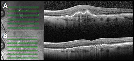 Figure 3. A 78-year-old female with newly diagnosed exudative AMD of the left eye, presenting with decreased vision and metamorphopsia. Vision on presentation was 20/50, and there was trace subretinal hemorrhage on exam. OCT of the left eye demonstrates a fibrovascular pigment epithelium detachment (PED) with overlying subretinal hyperreflective material (SHRM) and outer retinal hyper-reflective foci. This OCT feature is consistent with a mixed Type 1 (fvPED) and Type 2 (SHRM) neovascularization (A). OCT of the left eye 6 months later demonstrates resolution of SHRM and improvement of hyperreflective foci after initiation of anti-VEGF therapy every 5 weeks (B).