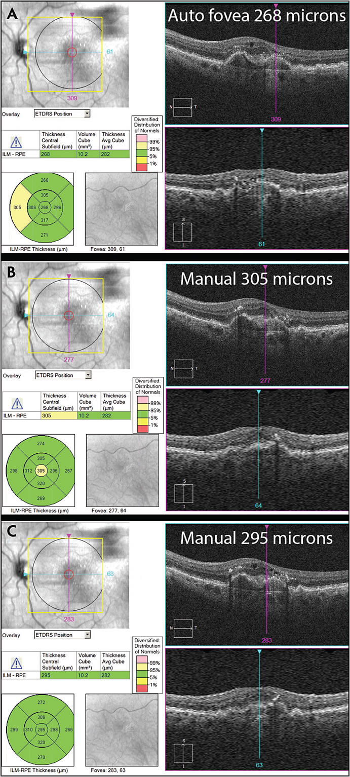 Figure 2. Example of an error due to incorrect foveal 
centration. The software-predicted foveal location results in a CST of 268 microns (A). Manually adjusting the ETDRS grid to improve the centration on the fovea results in a CST of 305 microns (B). Further adjustment of the ETDRS grid results in a change in CST from 305 microns to 295 microns, demonstrating the effects of small manual adjustments (C).