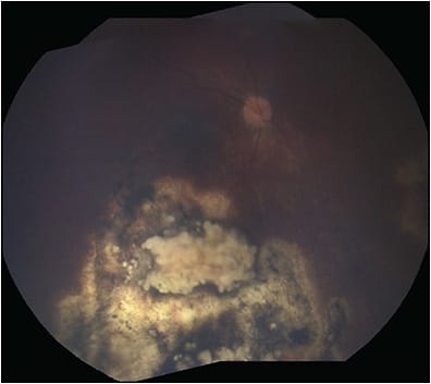 Figure 3. Regressed group D retinoblastoma after intra-arterial chemotherapy with melphalan, carboplatin, and topotecan.
