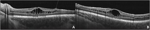Figure 2. Spectral-domain optical coherence tomography of the left eye of patient 1. Horizontal section (A) shows thick hyaloid with tenting of the inner limiting membrane and hyporeflective cavities in the ganglion cell layer and inner nuclear layer. Vertical section (B) demonstrates cysts in the inner nuclear layer, outer plexiform layer, and outer nuclear layer. Note the disposition of the cysts at the inferior junction of the outer plexiform layer and outer nuclear layer.
