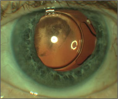 Figure 3. Opacified hydrophilic Akreos AO60 lens (Bausch &amp;#x2B; Lomb).