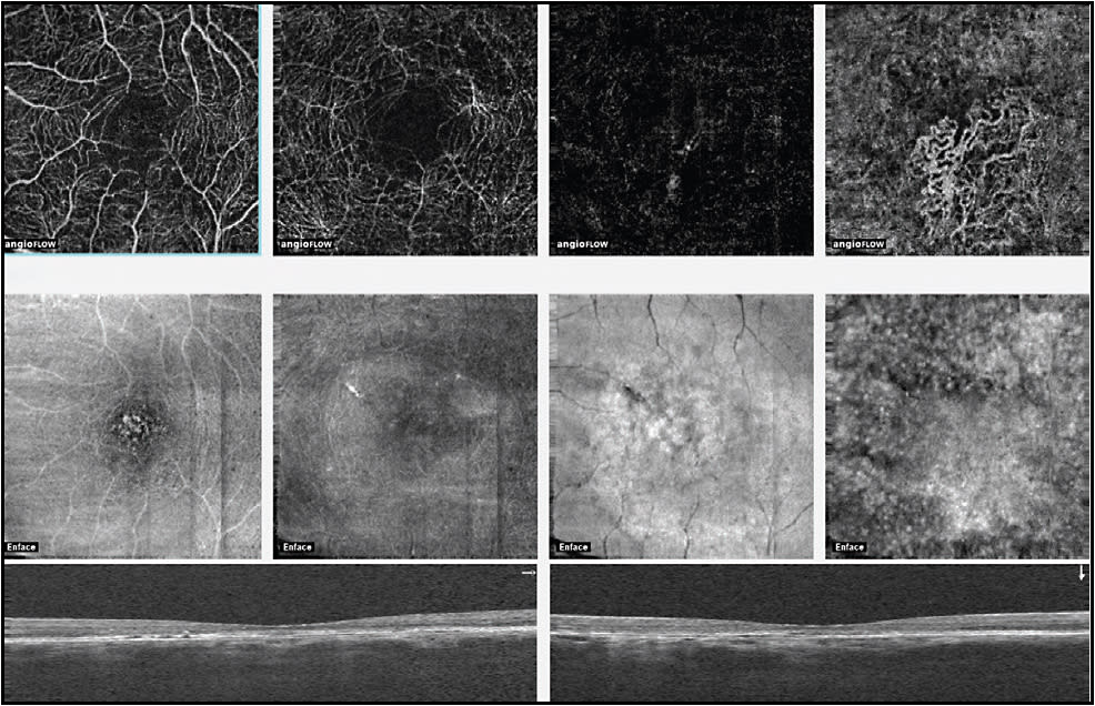 Figure 3. Inactive choroidal neovascularization in a 65-year-old male with a history of central serous chorioretinopathy.
