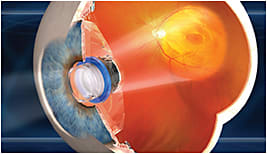 The VisionCare Implantable Miniature Telescope by Dr. Isaac Lipschitz.
