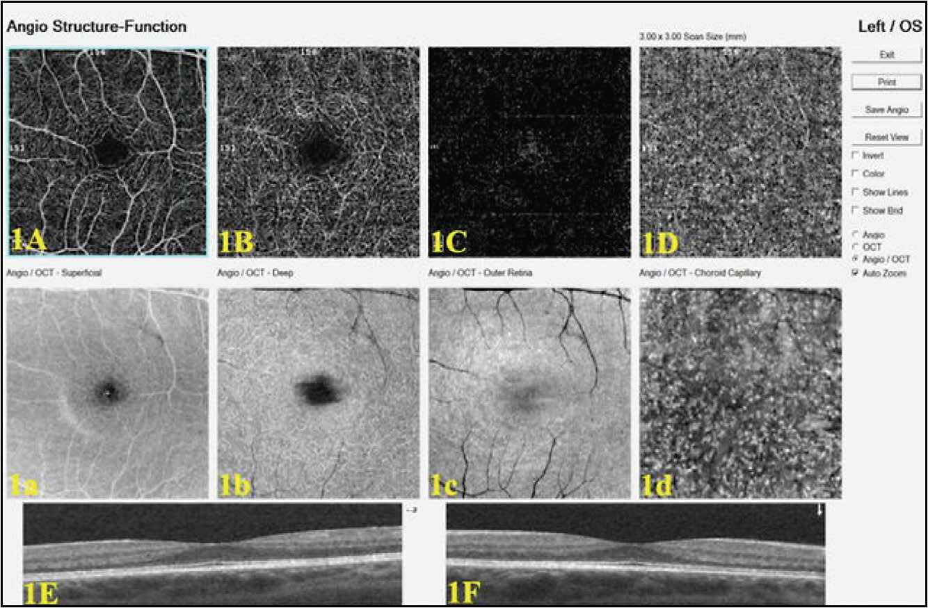 Figure 1. Normal OCT angiogram showing the segmentation of the retina into various slabs (Optovue AngioVue).