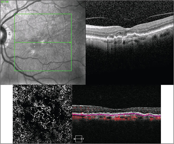 Figure 2. An 80-year-old female patient with exudative AMD in her right eye. Shallow, irregular, retinal pigment epithelium elevation was identified in the left eye, with no evidence of fluid (A). Optical coherence tomography angiography confirmed the presence of nonexudative macular neovascularization (B). The patient was followed for 3 years, with no development of exudation over time.