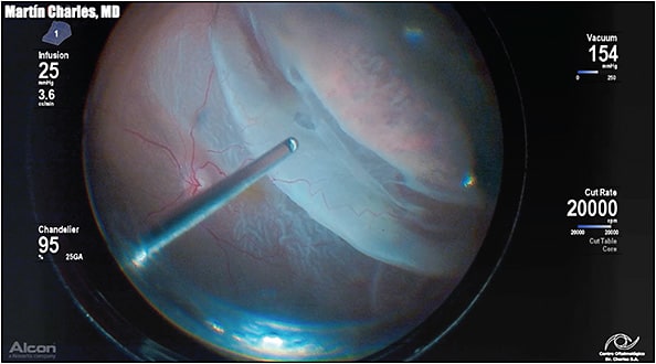 Figure 1. Autoscleral indentation using Alcon’s Hypervit probe, with excellent visualization provided by the chandelier light.