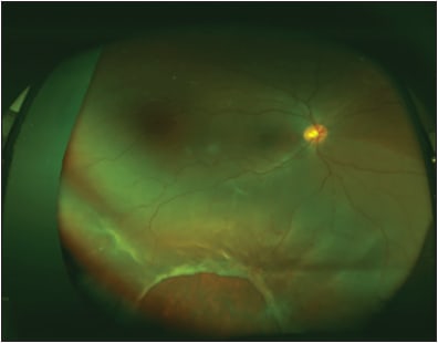 Figure 4. Fundus image of a pediatric patient with a large inferior retinal tear and macula-involving retinal detachment.