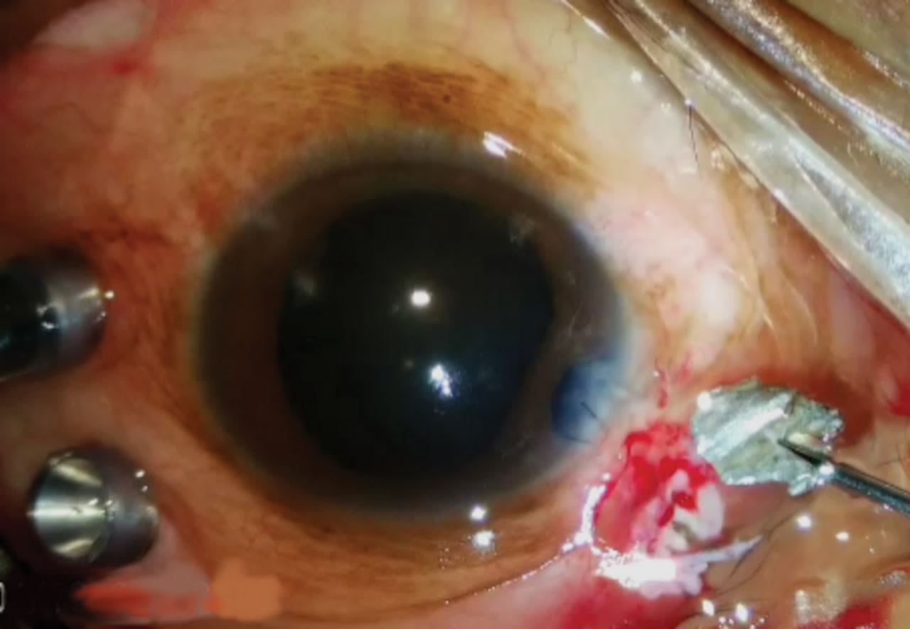 <p><strong>Figure 1. </strong>The intraocular foreign body (IOFB) has been extracted directly through the enlarged sclerotomy.</p>