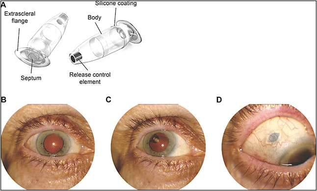 Figure 3. Ranibizumab Port Delivery System implant (PDS). Image A shows a PDS with 4 key components: (1) extrascleral flange anchoring the implant to the sclera, (2) self-sealing septum allowing for refills, (3) body containing ranibizumab, and (4) release element that controls the rate of ranibizumab release. Images B-D are clinical images from a PDS-implanted patient. The implant is visible in images C and D.13