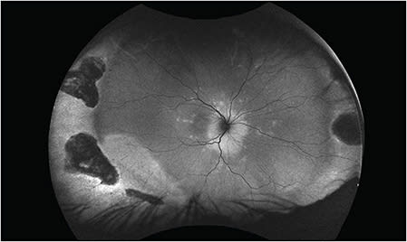 Figure 3. A 17-year-old female with a history of retinal detachment previously repaired with scleral buckle presents with acute zonal occult outer retinopathy-like changes seen on autofluorescence.
