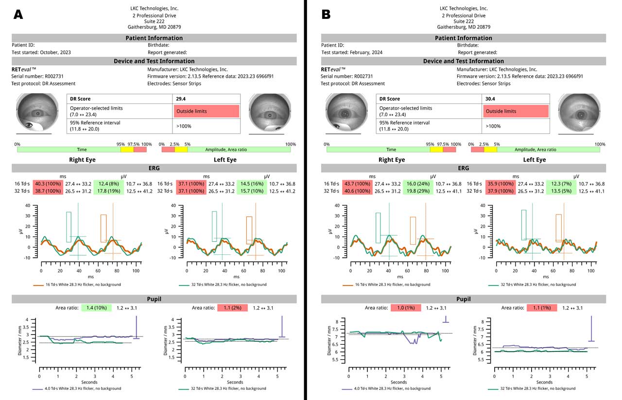 Figure 5. Serial RETeval ERGs at initial exam (A) and then 5 months later (B) in the same patient example described previously. Despite several initial injections of off-label bevacizumab, the diabetic retinopathy score worsened from 29.4 to 30.4, prompting the clinical decision to switch to on-label aflibercept intravitreal injections for subsequent treatments.