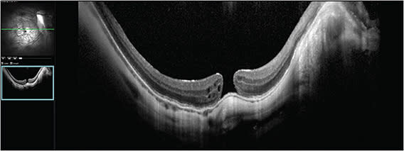 Figure 1. Optical coherence tomography image of a recurrent myopic macular hole of approximately 200 µm in the right eye of a 48-year-old male patient. Visual acuity was 20/64, the patient was pseudophakic, and the axial length was 34 mm.