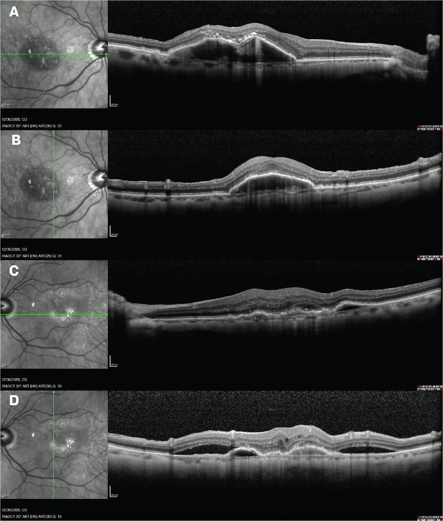 Figure 1. OCT scans—Dec. 30, 2020—from patient who is 1 month from his last aflibercept injection OU. Horizontal and vertical OCT OD scans show PED with intraretinal hyerreflectivity and trace SRF (A, B). OCT OS scans show shallow bilobed PED, SRF, and mild IRF (C,D).