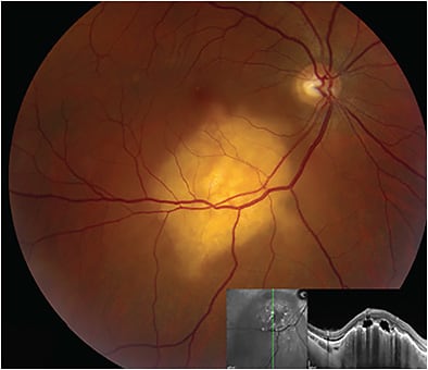 Figure 3. Imaging shows a choroidal metastatic lesion secondary to lung primary. Patient presented with a 6.0 x 5.0 x 1.5-mm elevated amelanotic choroidal lesion in the inferior macula, centered on the inferotemporal arcade, with slightly serpentine margins. The lesion extends to 500 microns from the foveal center and 500 microns from the inferotemporal edge of the optic nerve. There is mild mottled pigment over the lesion but no drusen or orange pigment. There is mild subretinal fluid at the foveal center and at the apex of the choroidal lesion. OCT imaging shows an elevated choroidal mass in the inferior macula with an irregular anterior surface margin and trace amounts of loculated subretinal fluid at its apex.