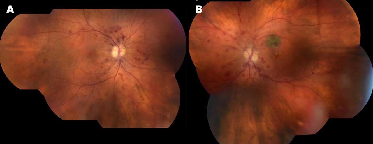 Figure 1. Right (A) and left (B) eye pseudowidefield color fundus montage images demonstrating severe nonproliferative diabetic retinopathy and macular edema in both eyes of a 68-year-old female who presented with vision loss. Four quadrants of dot-blot retinal hemorrhage indicate that at least severe nonproliferative diabetic retinopathy is present bilaterally. Hard yellow exudates suggest the presence of macular edema, as well as an incidental choroidal nevus in the left fundus.