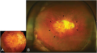 Figure 2. Fundus photo with staphyloma (both 50 degree and Optos). A. A 50-degree photo of right fundus shows diffuse chorioretinal atrophy, however, the presence of staphyloma is not obvious. B. Widefield fundus image by Optos clearly shows the border of wide staphyloma (outlined by arrowheads).