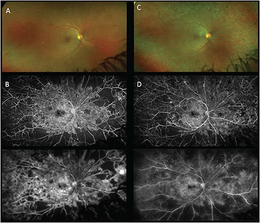 Figure 1. Fundus photo (A) from a 28-year-old patient with type 1 diabetes showing dot-blot hemorrhages and neovascularization nasally in the right eye. Prominent areas of early nonperfusion and significant late macular and vascular leakage are noted on fluorescein angiography (B). Panretinal photocoagulation is placed primarily to areas of nonperfusion as seen in fundus photograph (C). On the corresponding fluorescein angiogram (D), areas of nonperfusion appear less prominent