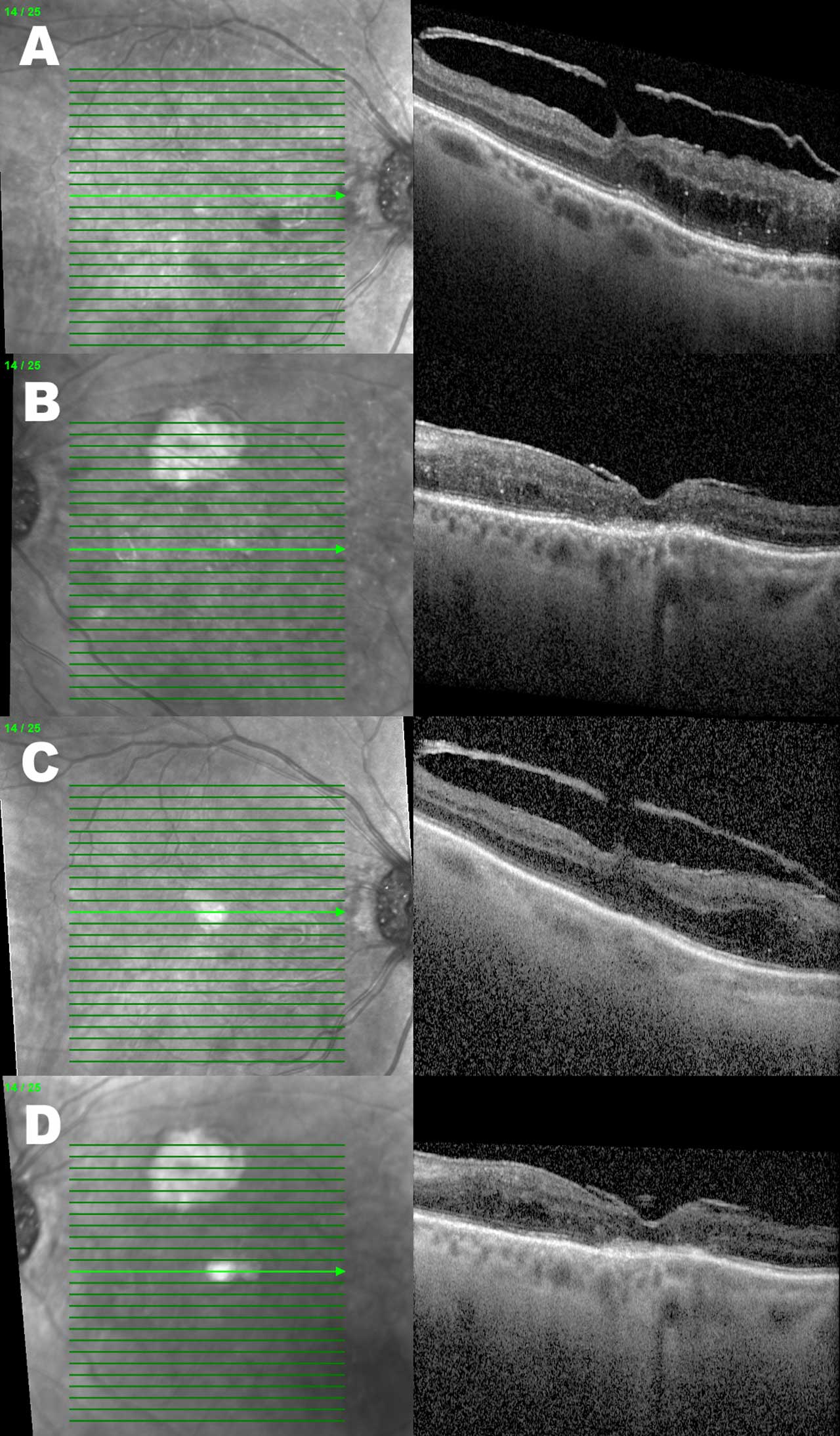 Figure 3. Right (A, C) and left (B, D) eye optical coherence tomography of the same patient example who received serial intravitreal injections over 5 months. Besides an overall reduction in the DME-associated retinal thickness, the right eye has a reduction in the quantity of hyper-reflective foci present. The presence of vitreomacular traction in the right eye may be contributing to more persistent intraretinal edema.