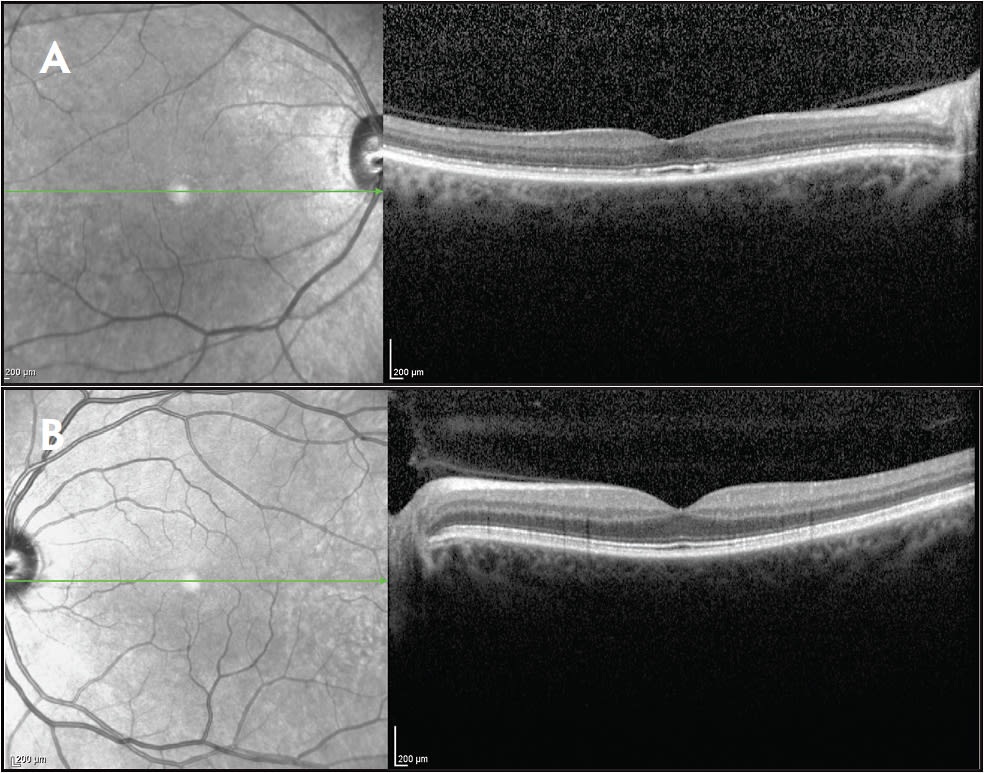 Figure 2. Spectral domain optical coherence tomography (OCT) image of the right and left eye. The central macular thickness was 229 microns in the right eye and 288 microns in the left eye (A). The right eye demonstrated disruption of the photoreceptor ellipsoid zone (inner segment-outer segment junction) with focal areas of photoreceptor loss. There is thinning of all retinal layers in the right eye. The left eye is normal (B).