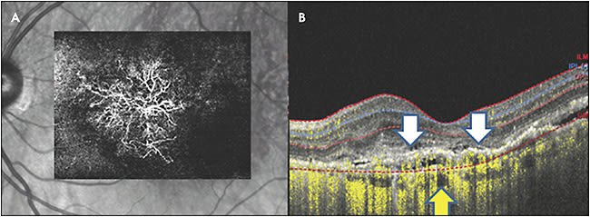 Figure 2. Computer-generated composite image of B scans showing choroidal neovascularization (A). One corresponding B scan with flow imaging showing pachy vessels (yellow arrows) and type 1 choroidal neovascularization (white arrows) (B).