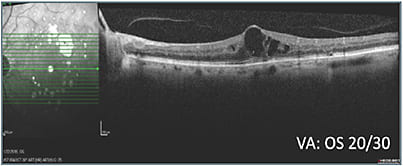 F: Status before treatment class switch OS