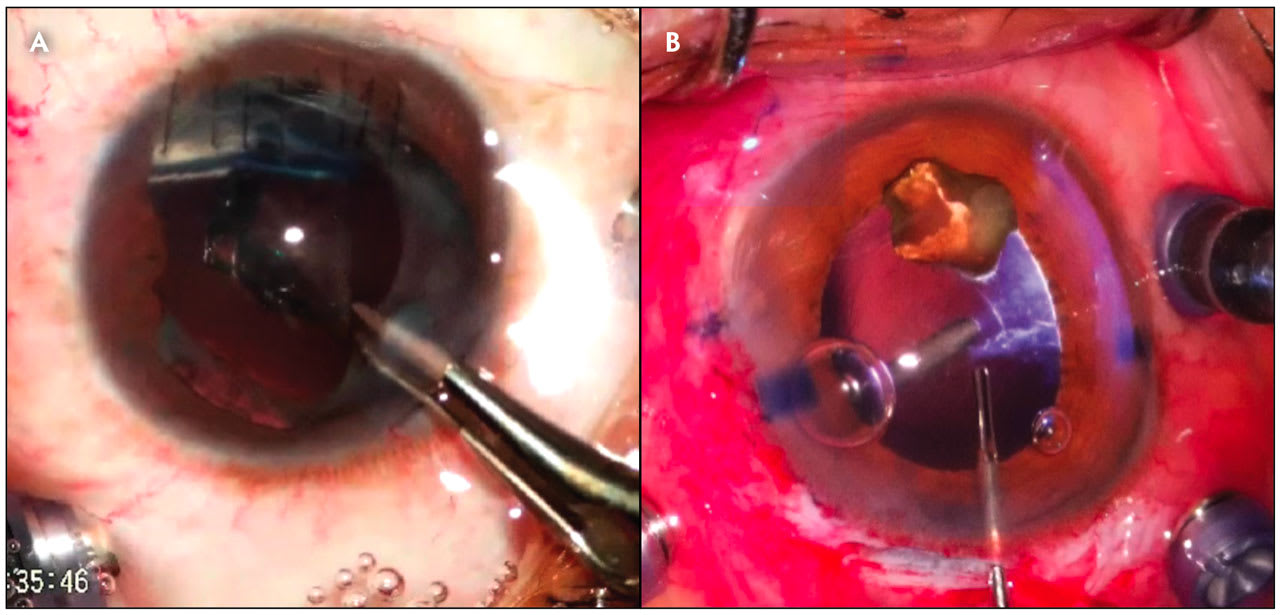 Figure 2. (A) Handshake technique with extraction through a scleral tunnel. In this case, a piece of glass is held by a lasso and then retrieved by the forceps. (B) The IOFB is placed on iris/capsule scaffold, assisted by OVD, and extracted through a scleral tunnel.