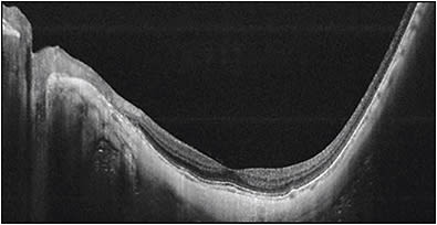 Figure 3. Steepened scleral curvature by OCT, which is confused with staphyloma. Swept-source OCT image across the fovea and the optic nerve shows the scleral curvature is steepened. However, there is no outpouching of the limited area of posterior sclera, suggesting posterior staphyloma.