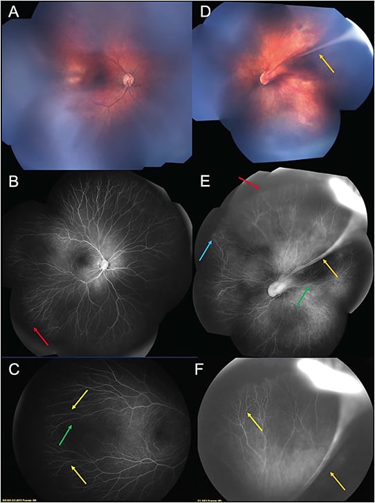 Figure 4. An 8-month-old female with familial exudative vitreoretinopathy. Contact fundus photography of the right eye shows an unremarkable fundus (A). Fluorescein angiogram of the right eye reveals subtle peripheral nonperfusion (red arrow) (B). Fluorescein angiogram at the periphery demonstrates pruning of the vessels (yellow) and straightening of the arcade (green arrow) (C). Fundus photography of the left eye demonstrates retinal fold (orange arrow) (D). Fluorescein angiogram of the left eye demonstrates retinal fold (orange arrow), changes and dragging of the retinal vasculature (green arrow), peripheral nonperfusion (red arrow) and peripheral leakage (blue arrow) (E). Fluorescein angiogram at the periphery demonstrates pruning and subtle sprouting of the vessels (yellow arrow) and the retinal fold (orange arrow) (F).