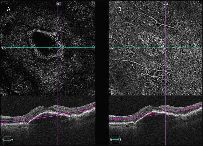 Figure 1. The automated segmentation of the “avascular” (A) and “deep” (B) retina do not properly adjust for the contours of the large RPE detachment present in this patient with treated neovascular AMD. The top images show the OCTA en face images, while the bottom images show the structure B-scan image, with segmentation lines. In both OCTA en face images on top, the hyperreflectivity seen centrally is a projection artifact on to the RPE, sections of which are captured in the automated segmentation algorithm.