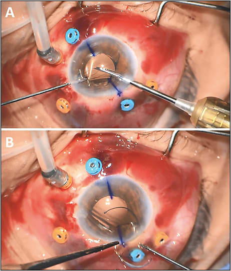 Figure 2. Grasp the optic with retina forceps through the paracentesis while using intraocular lens cutting scissors through the corneal wound to cut past the midway point along the axis of the haptics (A). Rotationally explant the intraocular lens through an approximately 3-mm corneal wound via “Pac-Man” technique (B).