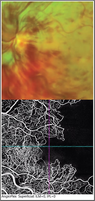 Figure 2. Ischemic central retinal vein occlusion, left eye. Top, fundus photography, demonstrating dilated, tortuous retinal veins, macular and disc edema, and intraretinal hemorrhages in each quadrant. Bottom, optical coherence tomography angiography demonstrating severe disruption of the foveal avascular zone and widespread ischemia in the superficial capillary plexus in the central and temporal macular regions.