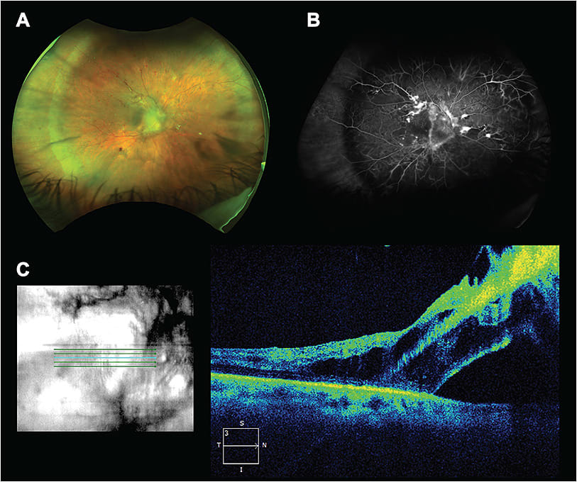 Figure 1. Widefield fundus photography (Optos) of a diabetic patient who developed a tractional retinal detachment involving the macular region (A). Fluorescein angiography reveals staining in the areas of fibrovascular traction and leakage in areas of neovascularization along the arcades and areas of capillary dropout (B). Optical coherence tomography (Cirrus; Zeiss) confirms a macula-involving tractional retinal detachment (C).
