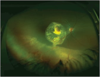 Figure 1. Ultrawidefield fundus image of a pediatric patient with Coats disease, which is characterized by abnormal retinal vasculature, as noted from telangiectasias, associated hemorrhages, and exudative deposits seen in the macula and inferior retina in this image.