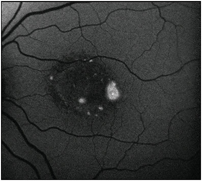 Figure 7. Multifocal Best disease. This patient developed several yolk-like submacular deposits, which appear as increased AF here on a background of decreased AF.