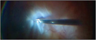 Figure 4. Heavy forceps, such as these Grieshaber MAXGrip forceps (Alcon), are an indispensable tool for peeling preretinal PVR membranes, performed here with the aid of indocyanine green staining.