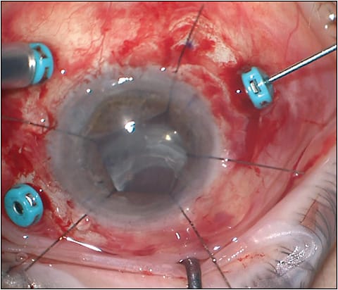 Figure 1.  Manual pupil dilation with iris hooks. This patient with prior history of endothelial keratoplasty and tube shunt placement underwent surgery for a dislocated intraocular lens/capsular bag complex. Due to a poor dilation, 5 flexible iris hooks were utilized to create a larger, pentagon-shaped pupil.