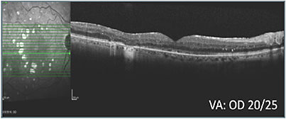 E: Status 28 weeks after treatment class switch OD