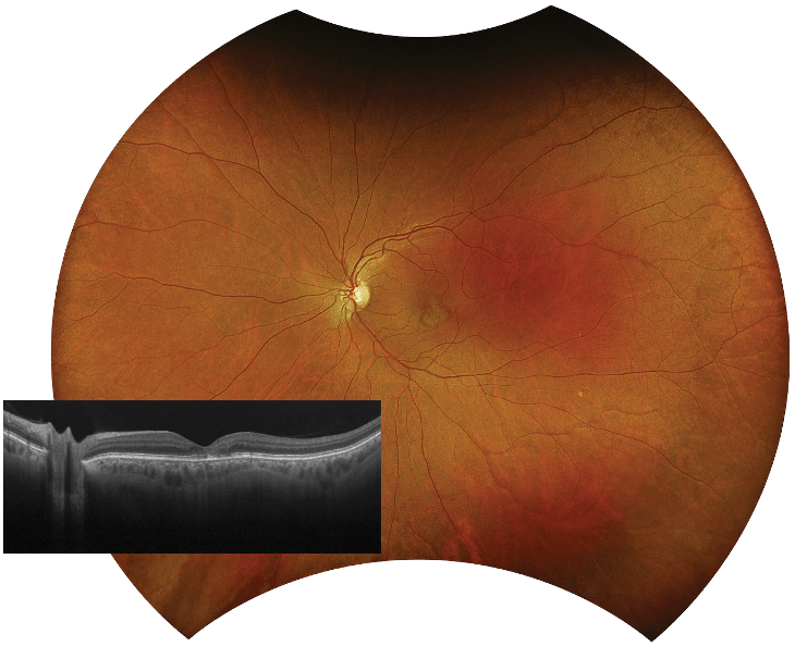 The device can seamlessly integrate eight, 200°, single shot, ultra-widefield retinal imaging modalities with optomap-navigated peripheral SS-OCT.