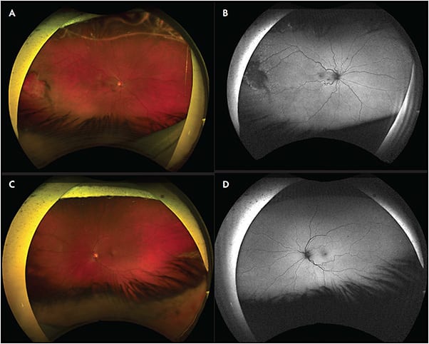 Figure 1. Fundus and red-free images of right eye (A, B) showing temporal retinal horseshoe tear with subclinical detachment and overlying vitreous hemorrhage well demarcated by laser. The left eye is within normal limits (C, D).