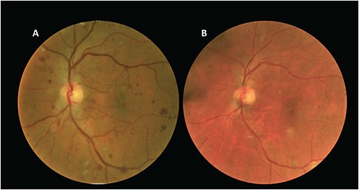 Figure 1. Retinal imaging from a 67-year-old male patient with diabetic macular edema who has received frequent anti-VEGF intravitreal injections for 2 years. Over this interval, note the improvement in his level of diabetic retinopathy from severe nonproliferative diabetic retinopathy (A) to mild-moderate nonproliferative diabetic retinopathy (B).