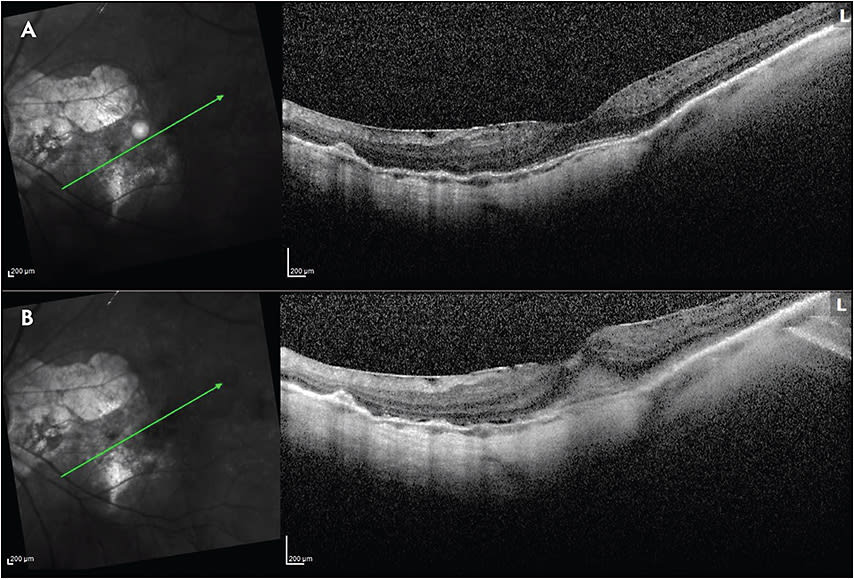 Figure 1.  A 95-year-old female with neovascular age-related macular degeneration in the left eye. Optical coherence tomography shows stabilized disease with no subretinal or intraretinal fluid on a regular regimen of anti-VEGF injections (A). Visual acuity was 20/60. The patient was lost to follow-up for 6 months and presented with acute vision loss (20/400) (B). Optical coherence tomography shows the presence of subretinal hyper-reflective material.
