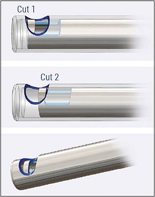 Figure 2. DORC two-dimensional cutter. Two cutting areas result in a continuous open aspiration port, with constant aspiration independent of flow.
IMAGE COURTESY DORC.