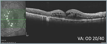 B: Status before treatment class switch OD